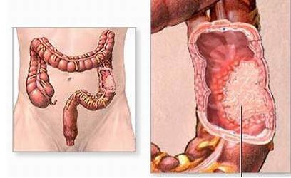 Viêm đại tràng giả mạc - Hình ảnh minh họa